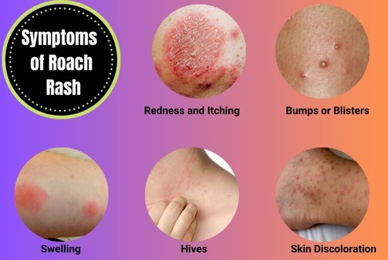 What Does a Roach Bite Look Like? Symptoms Photos and Treatment Tips