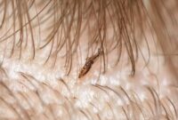 What Do Dead Lice Look Like? How to Tell If Treatment Worked