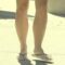 What Do Cankles Look Like? Causes Symptoms and Treatment Options