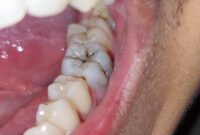 What Do Cavities Look Like on Molars? Hidden Signs You Shouldn’t Ignore
