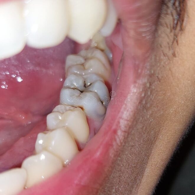 What Do Cavities Look Like on Molars? Hidden Signs You Shouldn’t Ignore