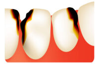 What Do Dental Caries Look Like? Visual Signs of Tooth Decay