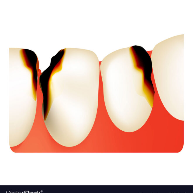 What Do Dental Caries Look Like? Visual Signs of Tooth Decay