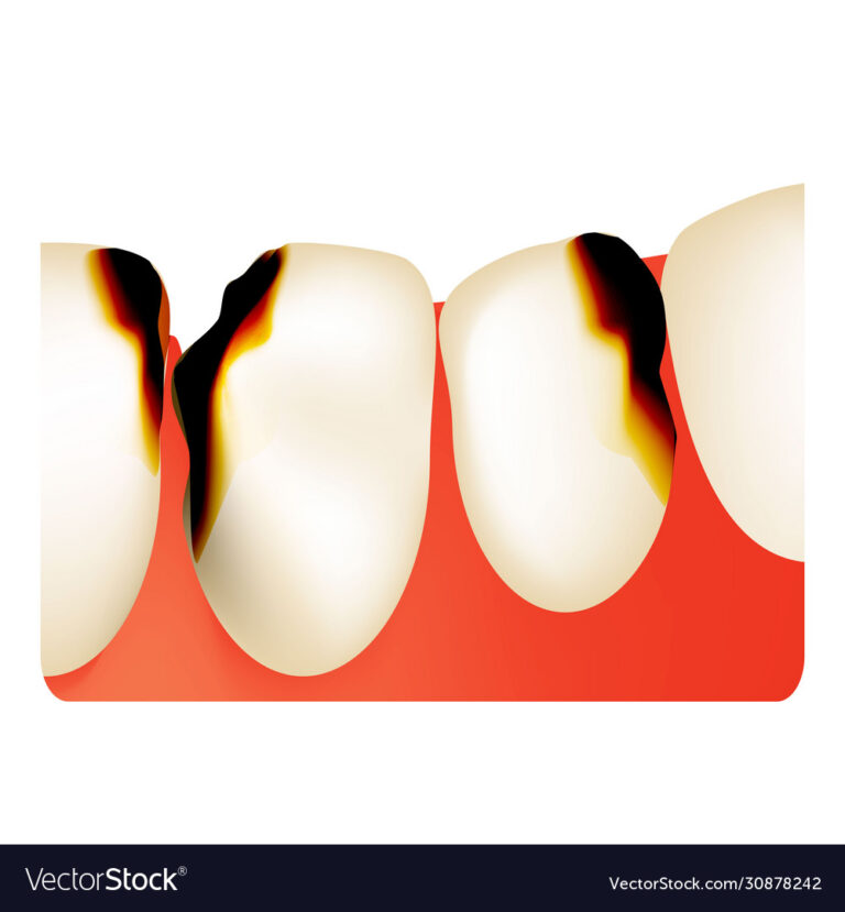 What Do Dental Caries Look Like? Visual Signs of Tooth Decay