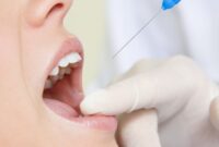 What Do Dentists Use for Numbing? Local Anesthesia Explained Simply