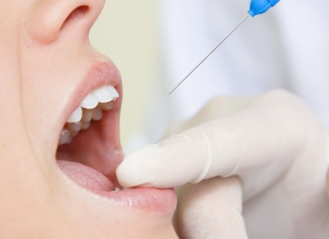 What Do Dentists Use for Numbing? Local Anesthesia Explained Simply