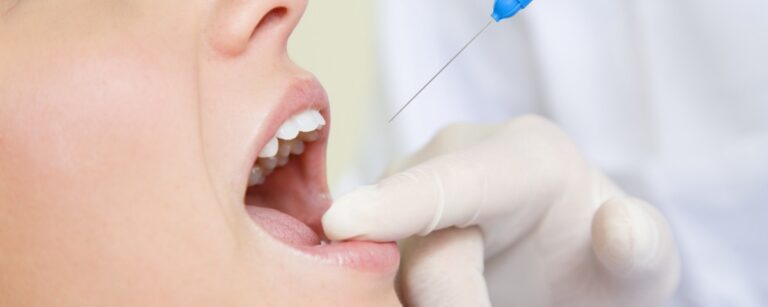 What Do Dentists Use for Numbing? Local Anesthesia Explained Simply