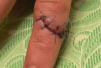 What Do Dissolve Stitches Look Like? Healing Stages and Care Tips