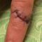 What Do Dissolve Stitches Look Like? Healing Stages and Care Tips
