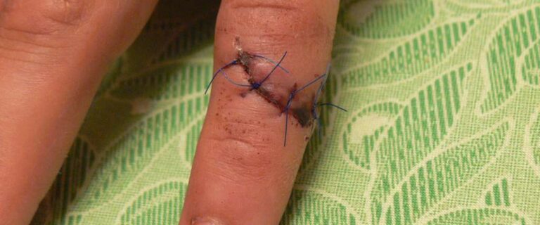 What Do Dissolve Stitches Look Like? Healing Stages and Care Tips