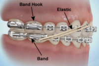 What Do Rubber Band Braces Do? How Elastics Move Your Teeth Faster