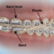 What Do Rubber Band Braces Do? How Elastics Move Your Teeth Faster