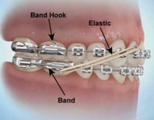 What Do Rubber Band Braces Do? How Elastics Move Your Teeth Faster