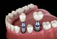 What Do Dental Implants Look Like? Before-and-After Smile Guide