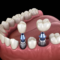 What Do Dental Implants Look Like? Before-and-After Smile Guide