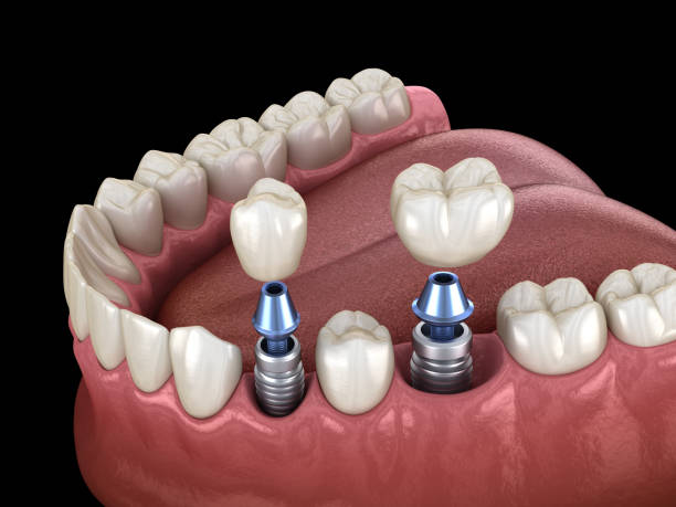 What Do Dental Implants Look Like? Before-and-After Smile Guide