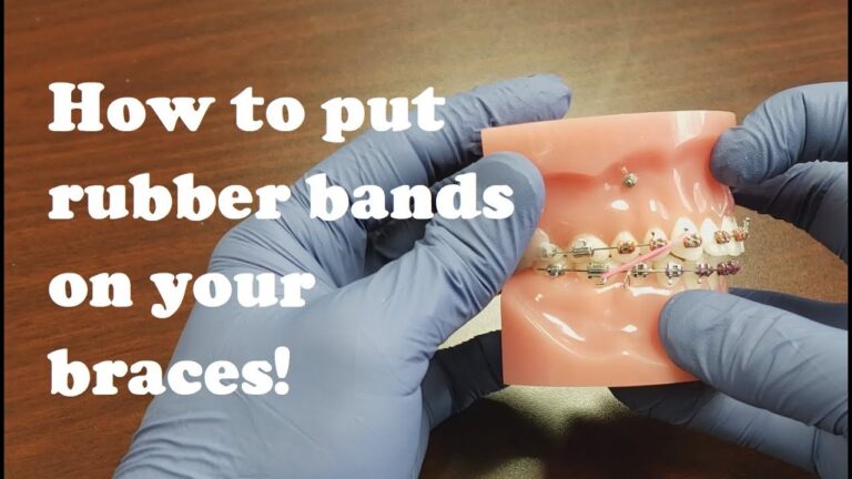 What Do Rubber Bands Do to Braces? How Elastics Move Teeth Faster
