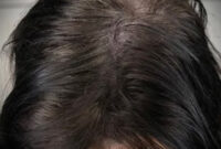 What Do Women Think of SMP Hair? Honest Opinions and Trends