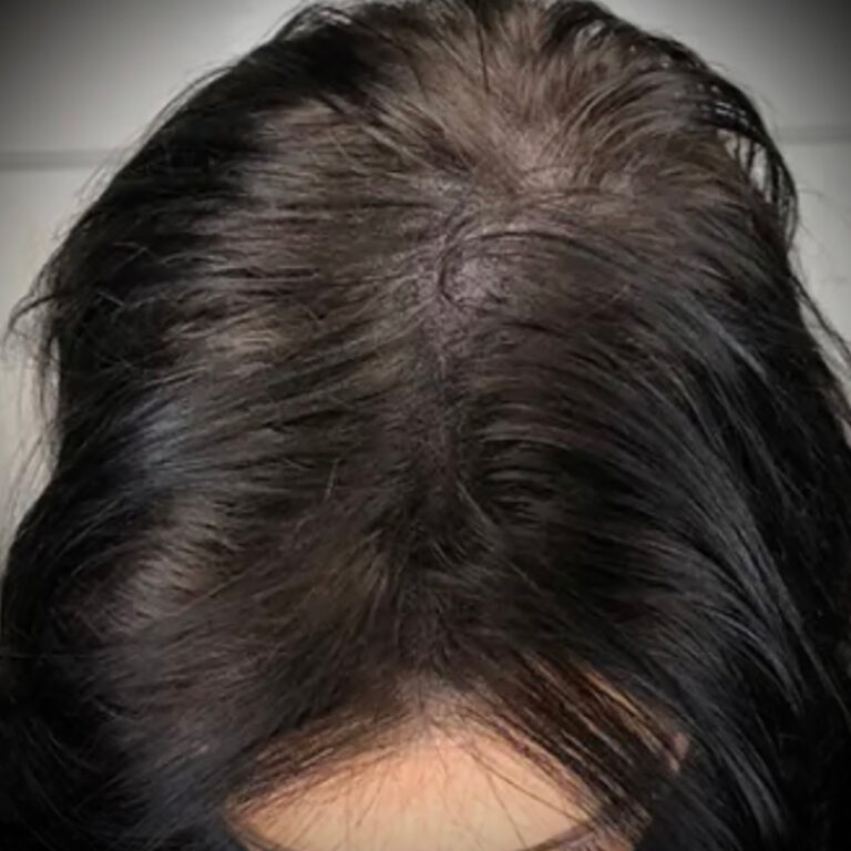 What Do Women Think of SMP Hair? Honest Opinions and Trends