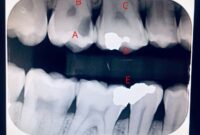 What Do Cavities Look Like on an X-Ray? Dental Images Explained