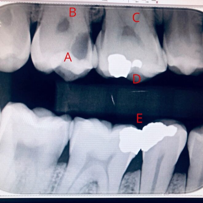 What Do Cavities Look Like on an X-Ray? Dental Images Explained