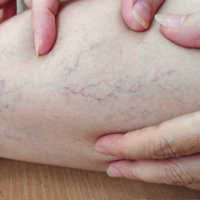 What Do Blue Veins Mean? Causes Health Clues and When to Worry
