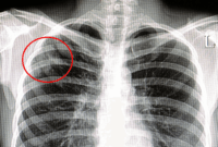 Who Requires TB Testing for Healthcare Workers?