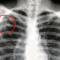 Who Requires TB Testing for Healthcare Workers?