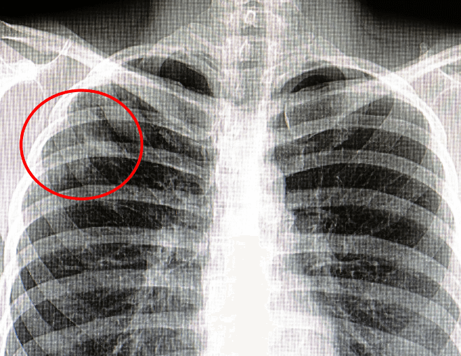 Who Requires TB Testing for Healthcare Workers?