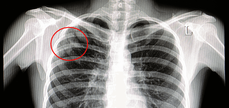 Who Requires TB Testing for Healthcare Workers?