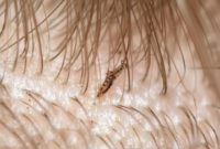 What Do Dead Lice Look Like? How to Tell If Treatment Worked