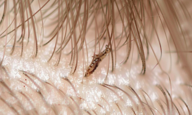 What Do Dead Lice Look Like? How to Tell If Treatment Worked