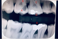 What Do Cavities Look Like on an X-Ray? Dental Images Explained