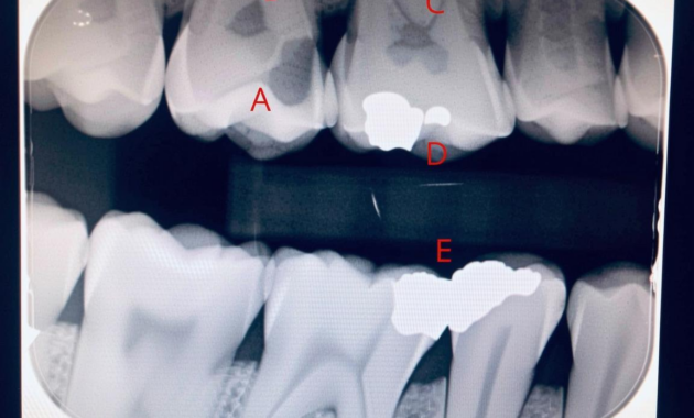 What Do Cavities Look Like on an X-Ray? Dental Images Explained