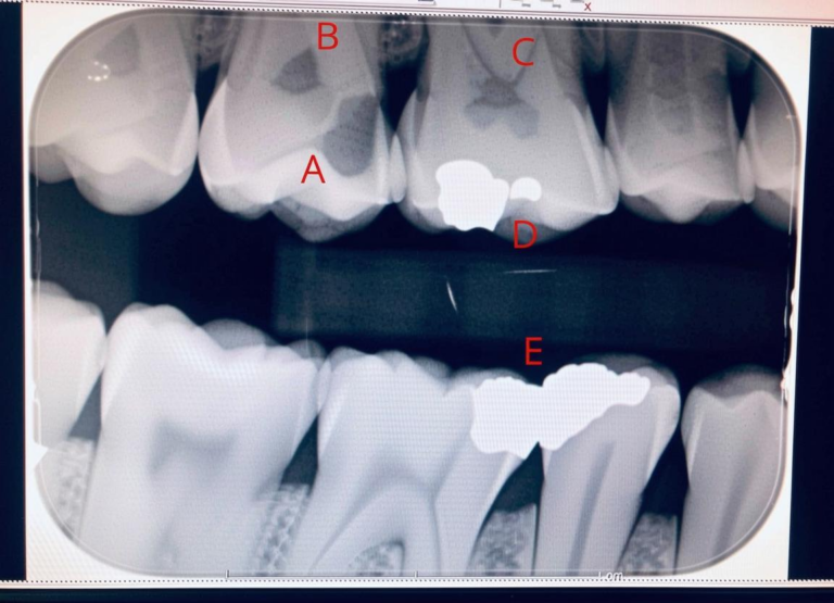 What Do Cavities Look Like on an X-Ray? Dental Images Explained